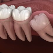 affordable wisdom  teeth removal