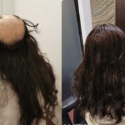 Hair Replacement  Singapore
